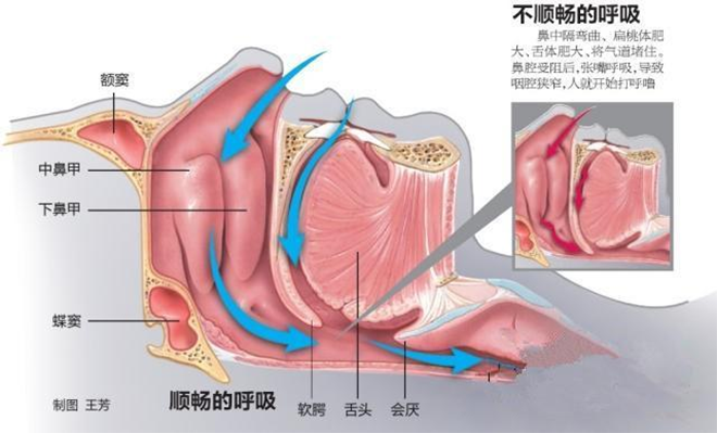 家用呼吸機是如何治療打鼾