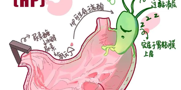 【必看】幽門螺桿菌真相揭示，別再忽視你的胃痛了！